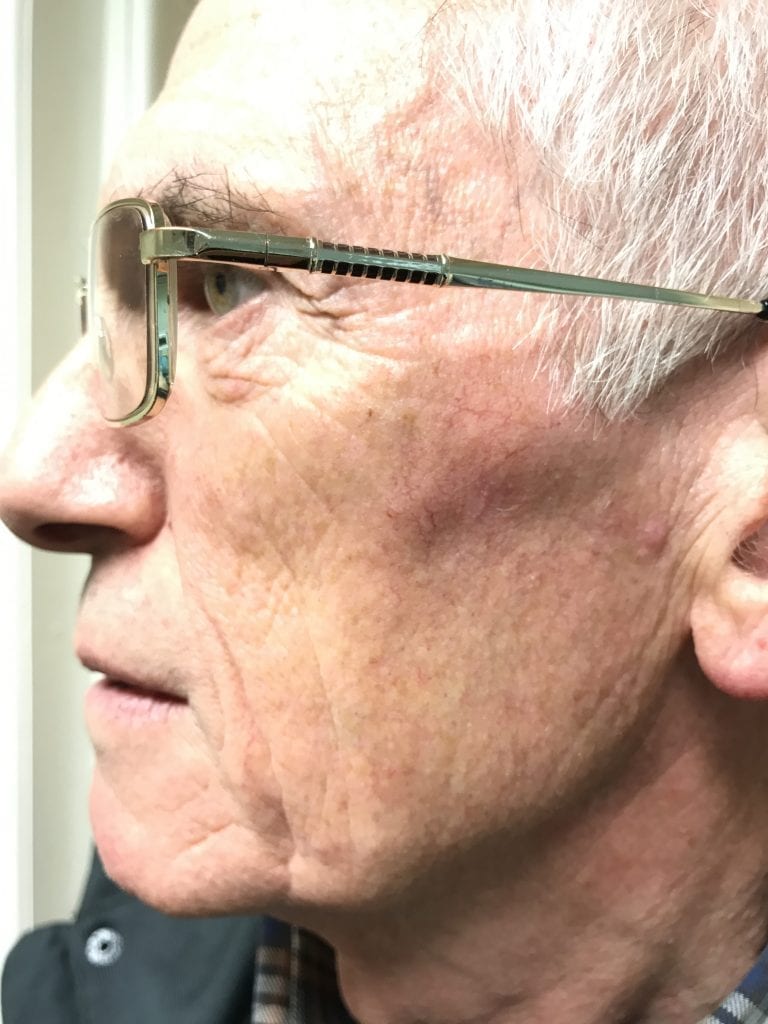 Private Laser Mole Removal UK - Cost & Booking